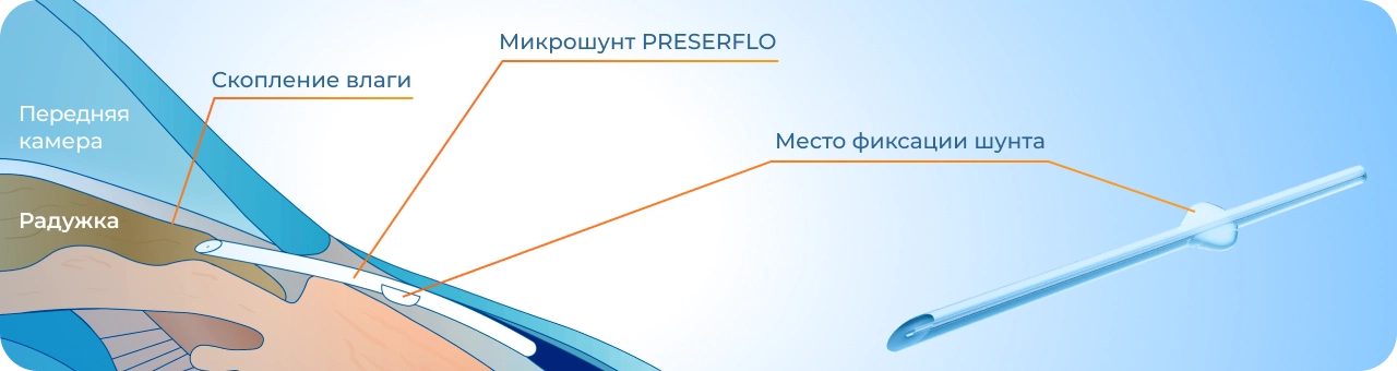 лечение глаукомы при помощи микрошунта PreserFlo