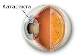Лечение катаракт глаз в новосибирске thumbnail